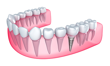 Vero Beach Dental Implants | Raymond A. Della Porta, II DMD